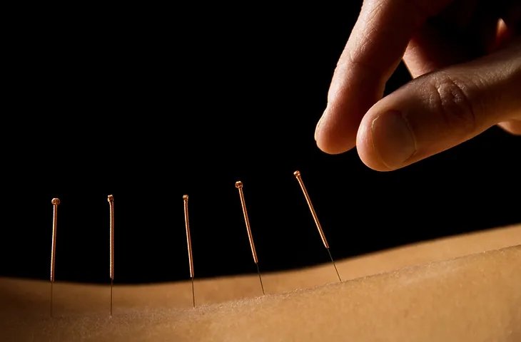 dry needling latitude pt