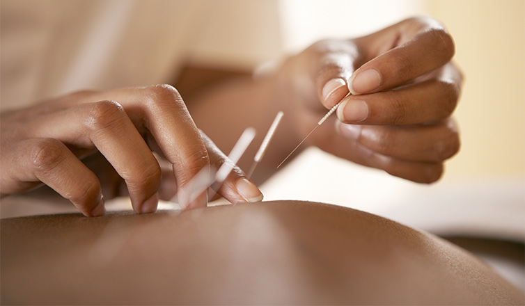 what is dry needling